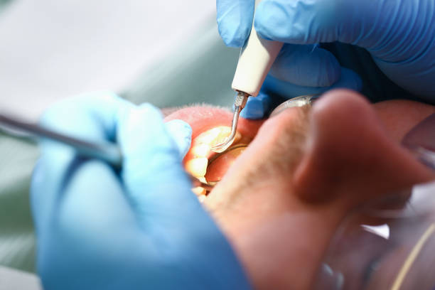 Best Emergency Dental Care for Broken or Chipped Teeth in Tracyton, WA